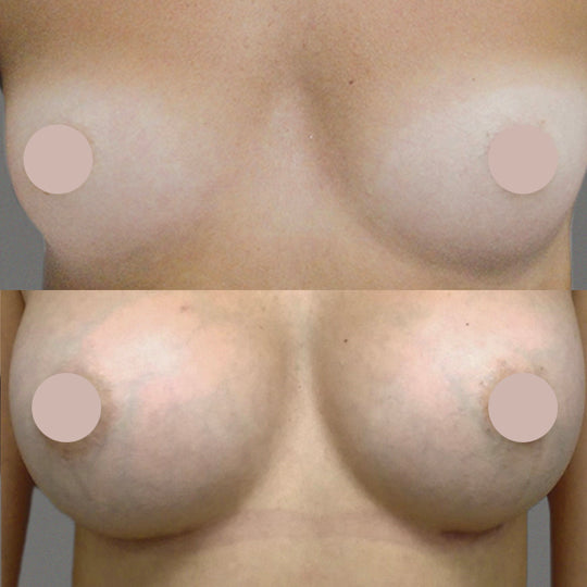 Breast augmentation before/after