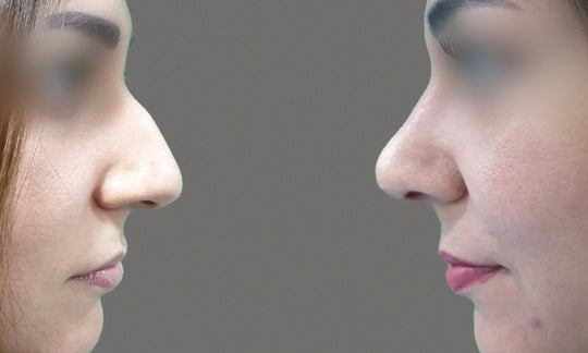 Rhinoplasty Before/After